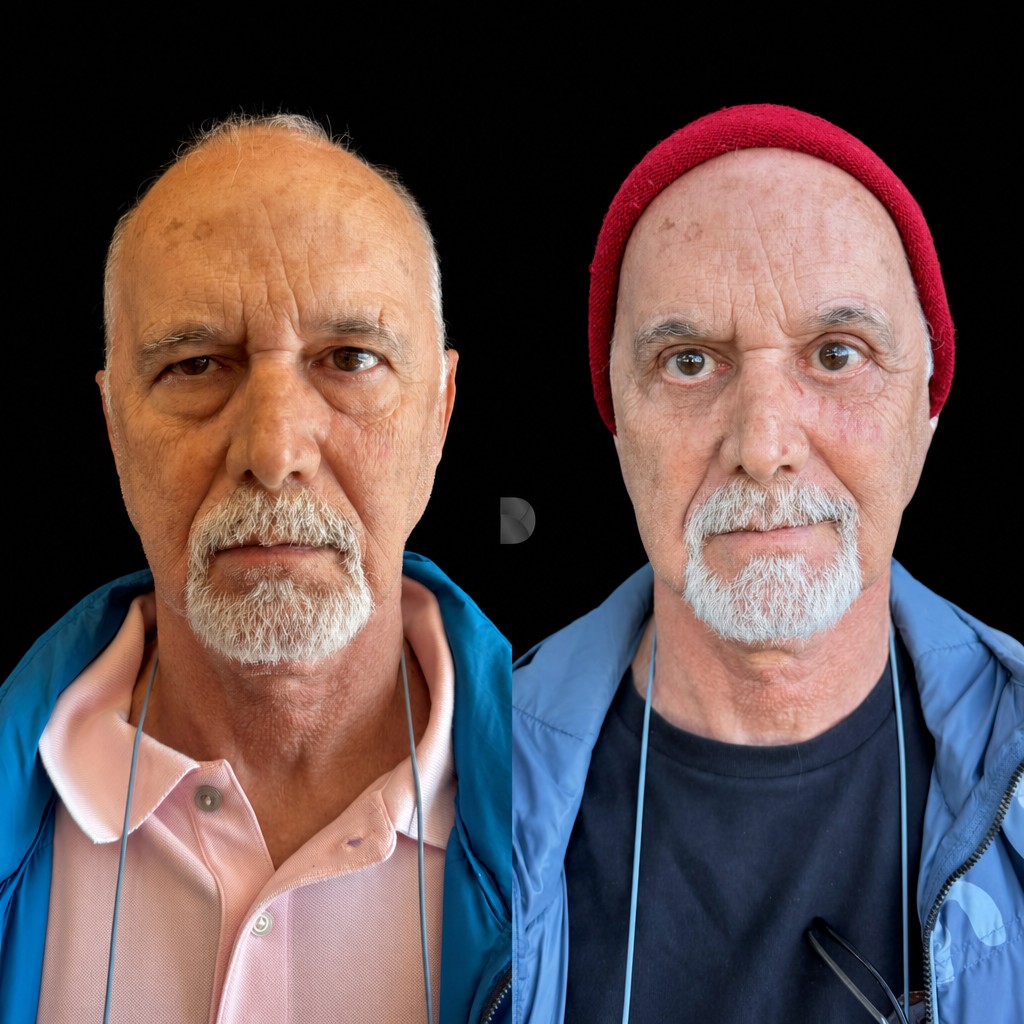Antes e depois de blefaroplastia no Instituto Donna